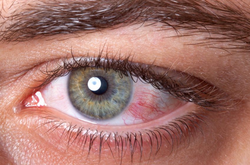  ¿Es posible contagiarse de Coronavirus por los ojos?