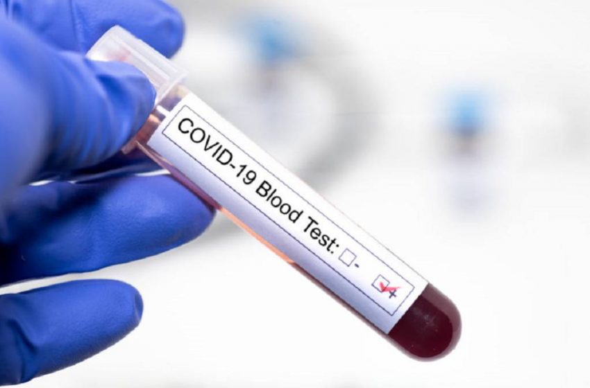  Suman 134 nuevos casos de Covid-19 en la región de Antogafasta