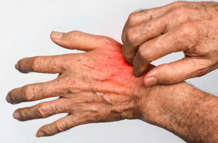  ¿Qué es la sarna Noruega? Cómo detectarla y cuáles son sus principales síntomas