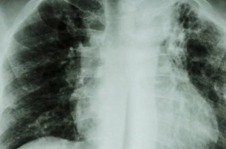Salud descarta brote de tuberculosis en Calama tras confirmar dos casos en estudiantes