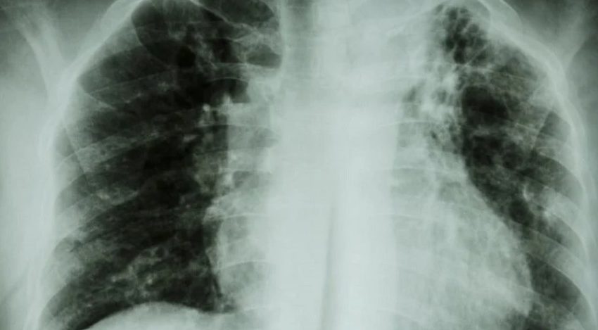  Salud descarta brote de tuberculosis en Calama tras confirmar dos casos en estudiantes